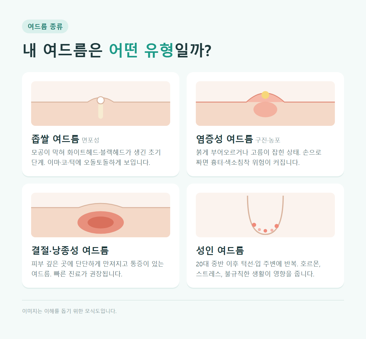 좁쌀 여드름, 염증성 여드름, 결절 낭종성 여드름, 성인 여드름 유형 모식도
